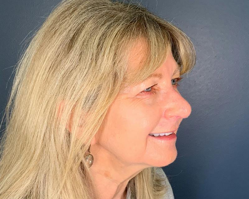 Rhinoplasty Before & After Gallery - Patient 344324 - Image 6