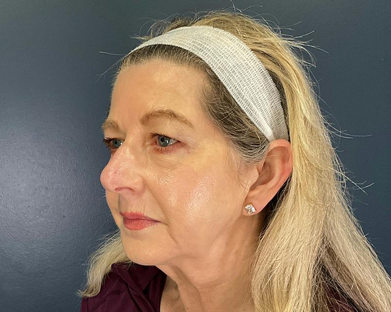 Rhinoplasty Before & After Gallery - Patient 344324 - Image 7