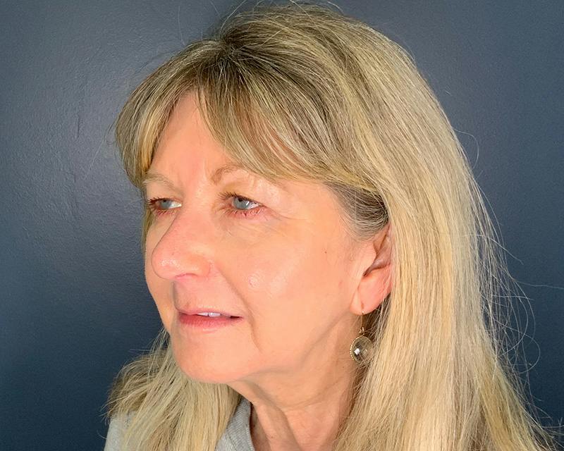 Rhinoplasty Before & After Gallery - Patient 344324 - Image 8
