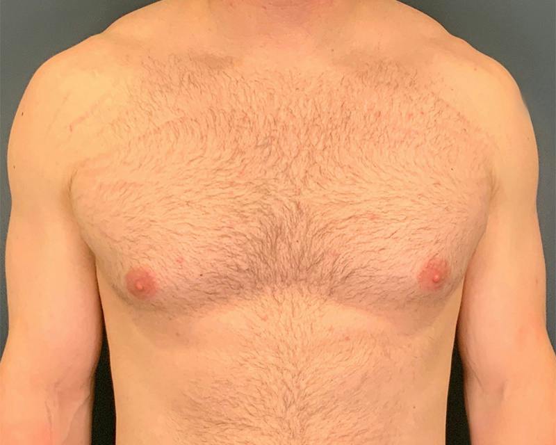 Male Breast Reduction Before & After Gallery - Patient 425530 - Image 1