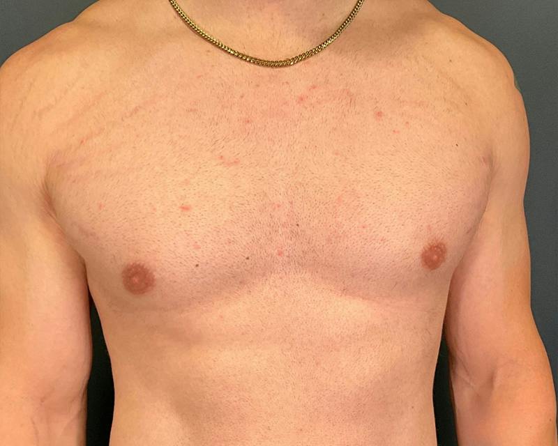 Male Breast Reduction Before & After Gallery - Patient 425530 - Image 2