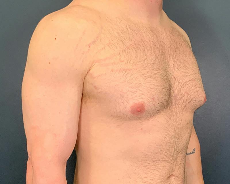 Male Breast Reduction Before & After Gallery - Patient 425530 - Image 3