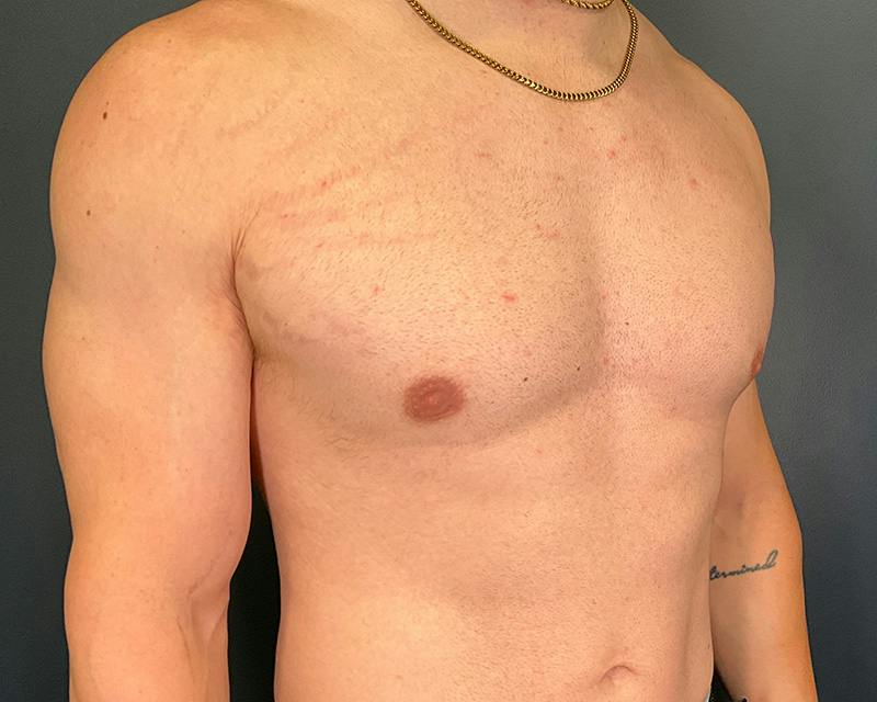 Male Breast Reduction Before & After Gallery - Patient 425530 - Image 4