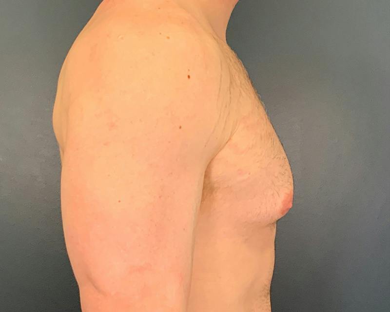 Male Breast Reduction Before & After Gallery - Patient 425530 - Image 5