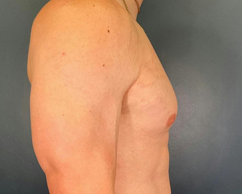 Male Breast Reduction Before & After Gallery - Patient 425530 - Image 6