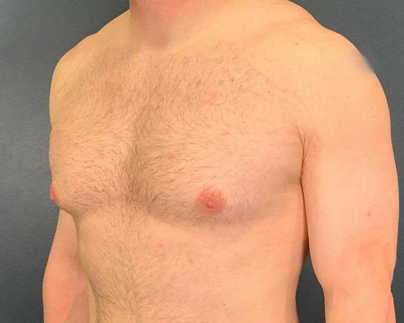 Male Breast Reduction Before & After Gallery - Patient 425530 - Image 7