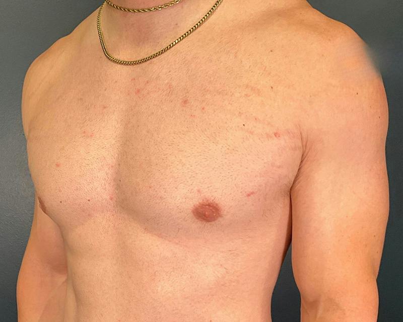 Male Breast Reduction Before & After Gallery - Patient 425530 - Image 8