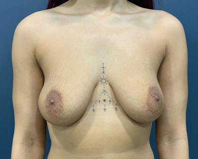 Breast Augmentation Before & After Gallery - Patient 177047 - Image 1