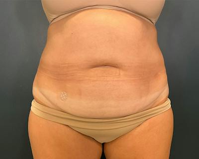 Liposuction Before & After Gallery - Patient 158668 - Image 1