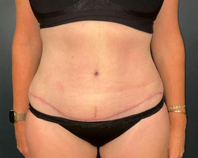 Liposuction Before & After Gallery - Patient 158668 - Image 2