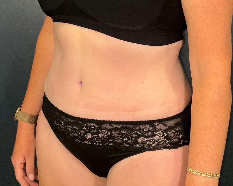 Tummy Tuck Before & After Gallery - Patient 108414 - Image 6