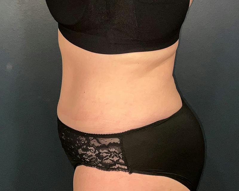 Tummy Tuck Before & After Gallery - Patient 108414 - Image 8