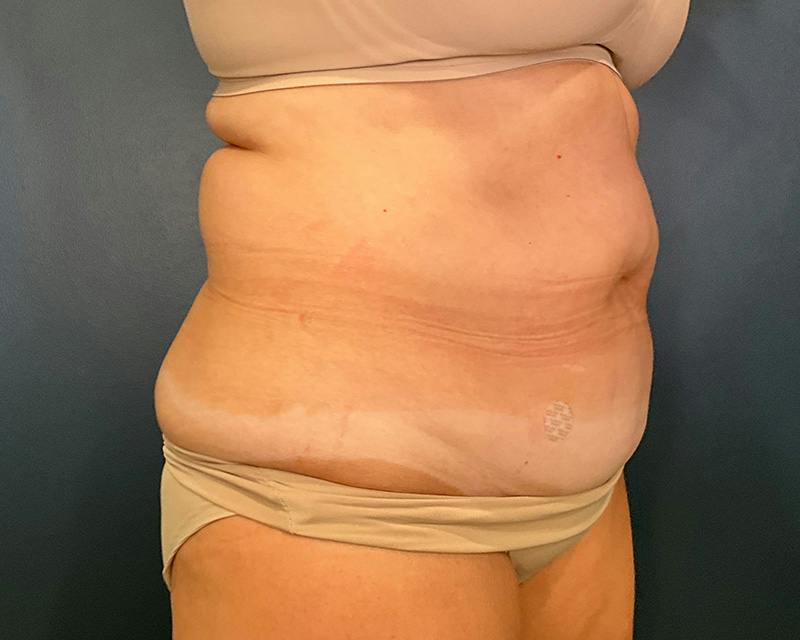 Tummy Tuck Before & After Gallery - Patient 108414 - Image 3