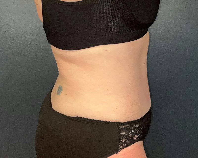 Tummy Tuck Before & After Gallery - Patient 108414 - Image 4