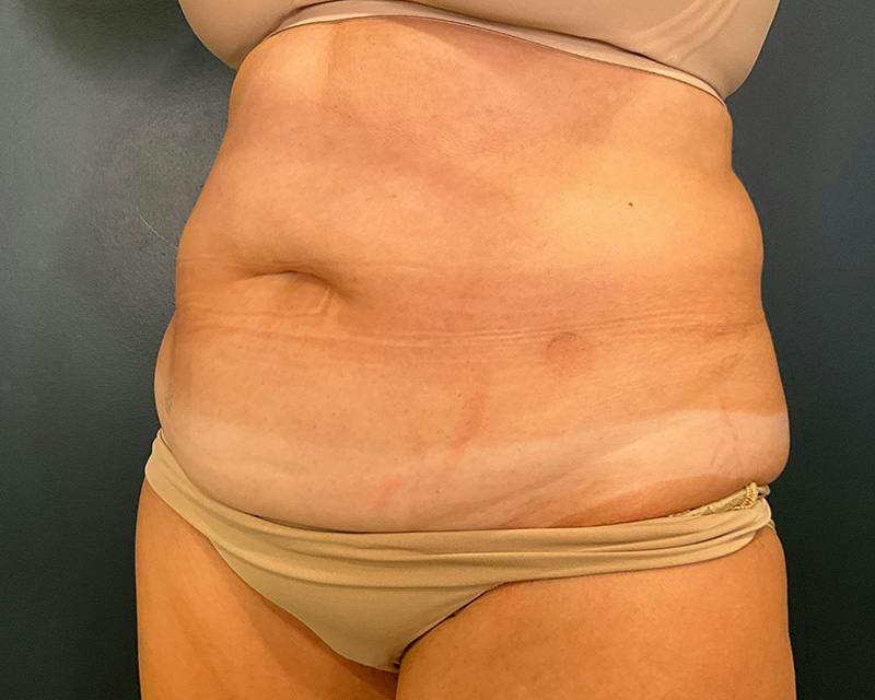 Tummy Tuck Before & After Gallery - Patient 108414 - Image 5