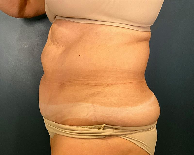 Tummy Tuck Before & After Gallery - Patient 108414 - Image 7