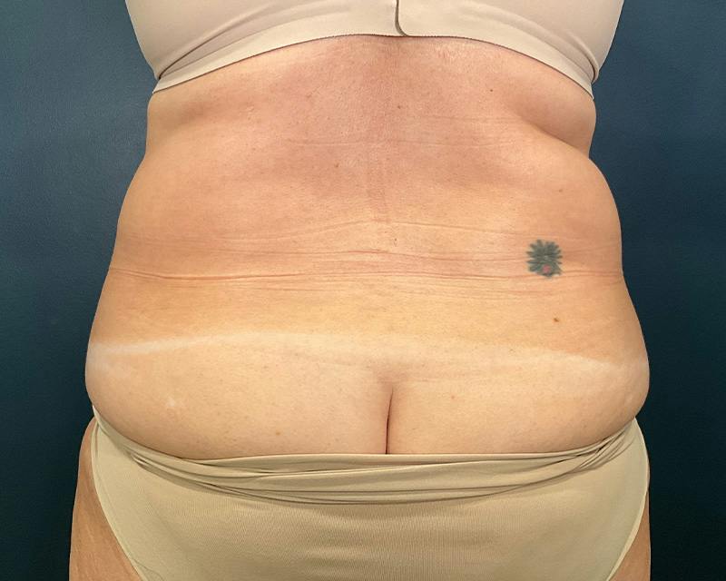 Tummy Tuck Before & After Gallery - Patient 108414 - Image 9