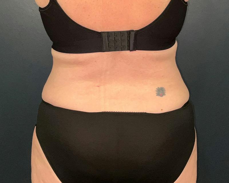 Tummy Tuck Before & After Gallery - Patient 108414 - Image 10