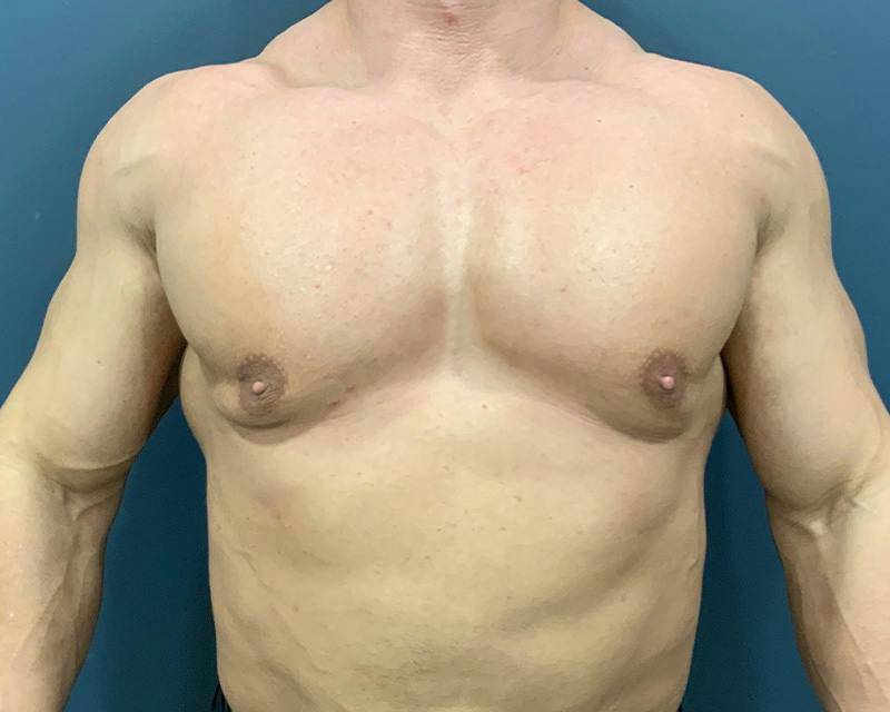 Male Breast Reduction Before & After Gallery - Patient 198790 - Image 1