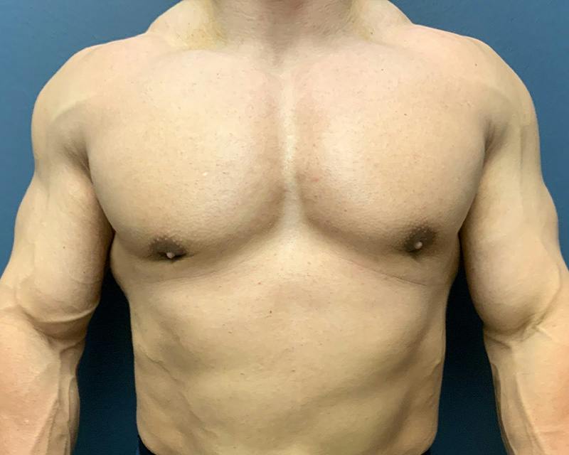 Male Breast Reduction Before & After Gallery - Patient 198790 - Image 2