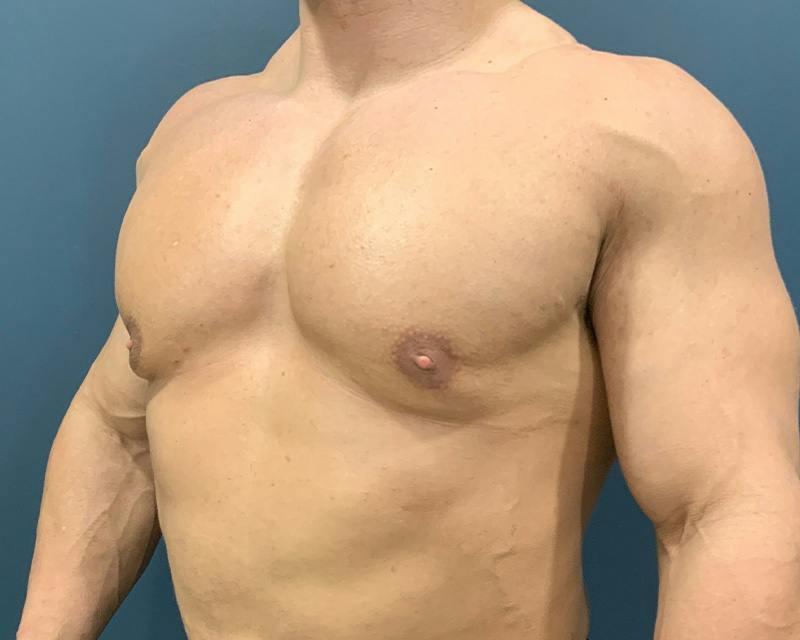 Male Breast Reduction Before & After Gallery - Patient 198790 - Image 5