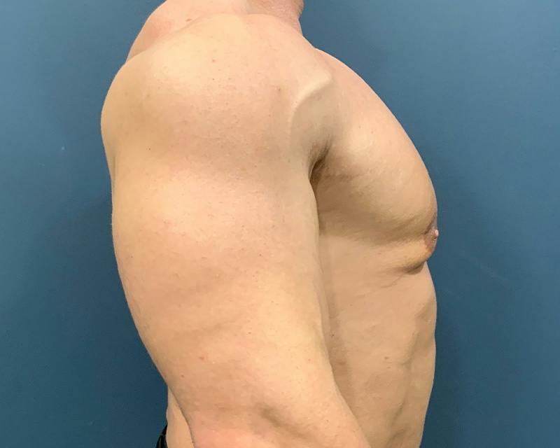 Male Breast Reduction Before & After Gallery - Patient 198790 - Image 3