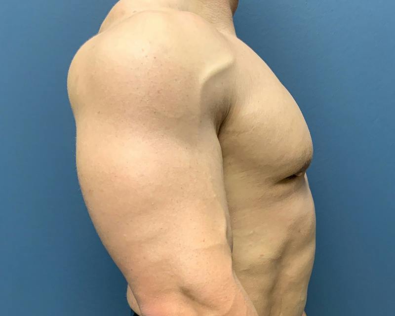 Male Breast Reduction Before & After Gallery - Patient 198790 - Image 4
