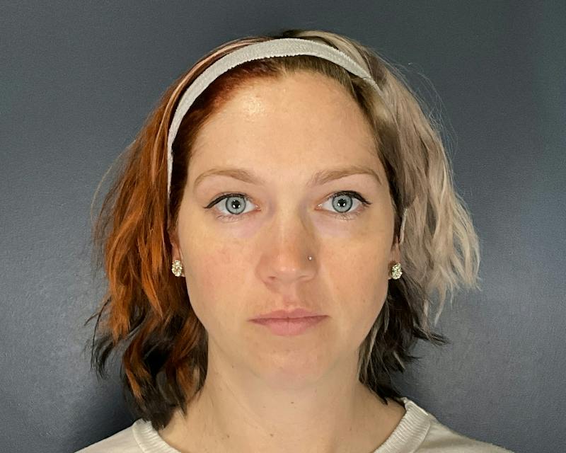 Chin Augmentation Before & After Gallery - Patient 313699 - Image 5