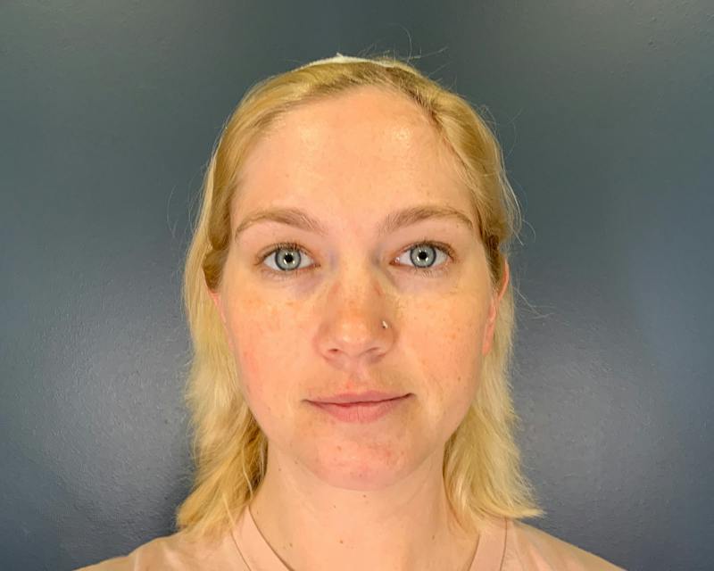 Chin Augmentation Before & After Gallery - Patient 313699 - Image 6