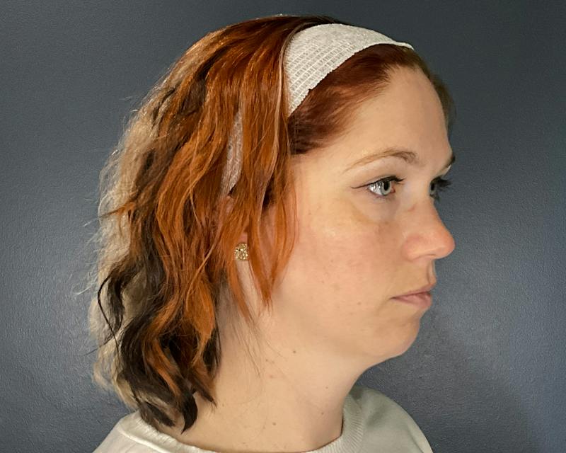 Chin Augmentation Before & After Gallery - Patient 313699 - Image 3