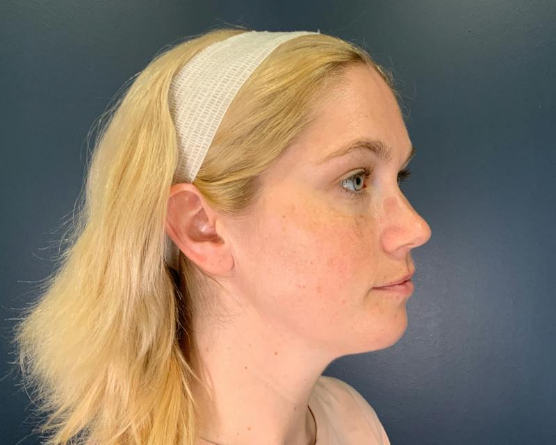 Chin Augmentation Before & After Gallery - Patient 313699 - Image 4