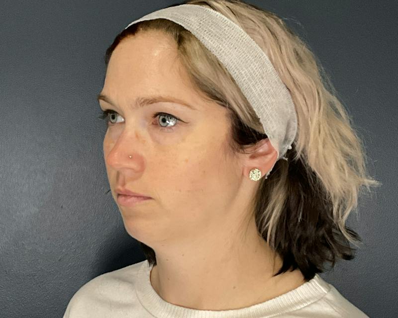 Chin Augmentation Before & After Gallery - Patient 313699 - Image 7
