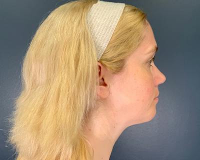Chin Augmentation Before & After Gallery - Patient 313699 - Image 2
