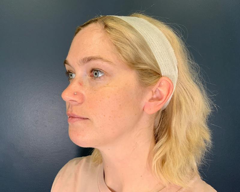 Chin Augmentation Before & After Gallery - Patient 313699 - Image 8