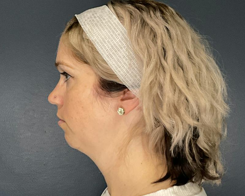Chin Augmentation Before & After Gallery - Patient 313699 - Image 9