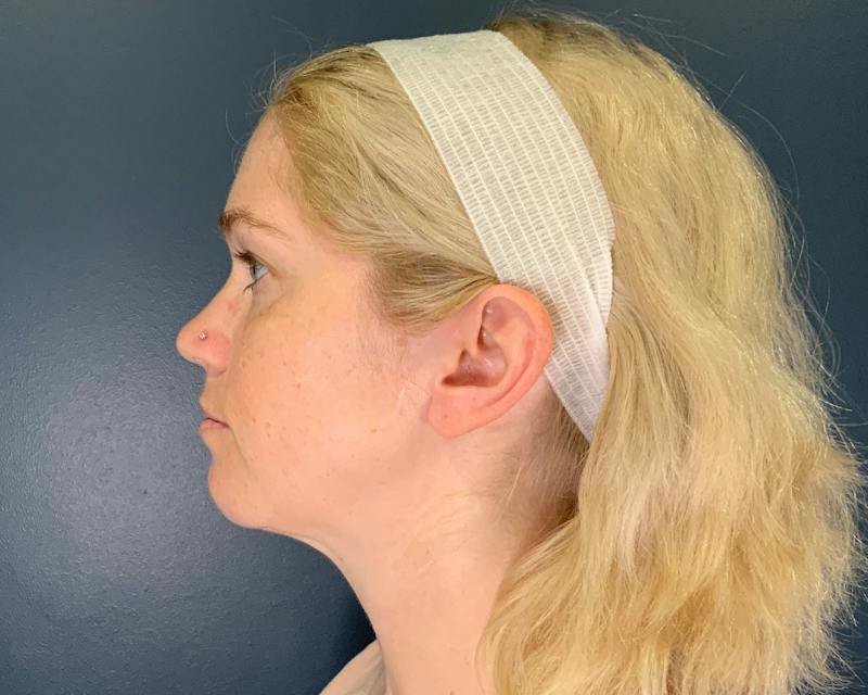 Chin Augmentation Before & After Gallery - Patient 313699 - Image 10