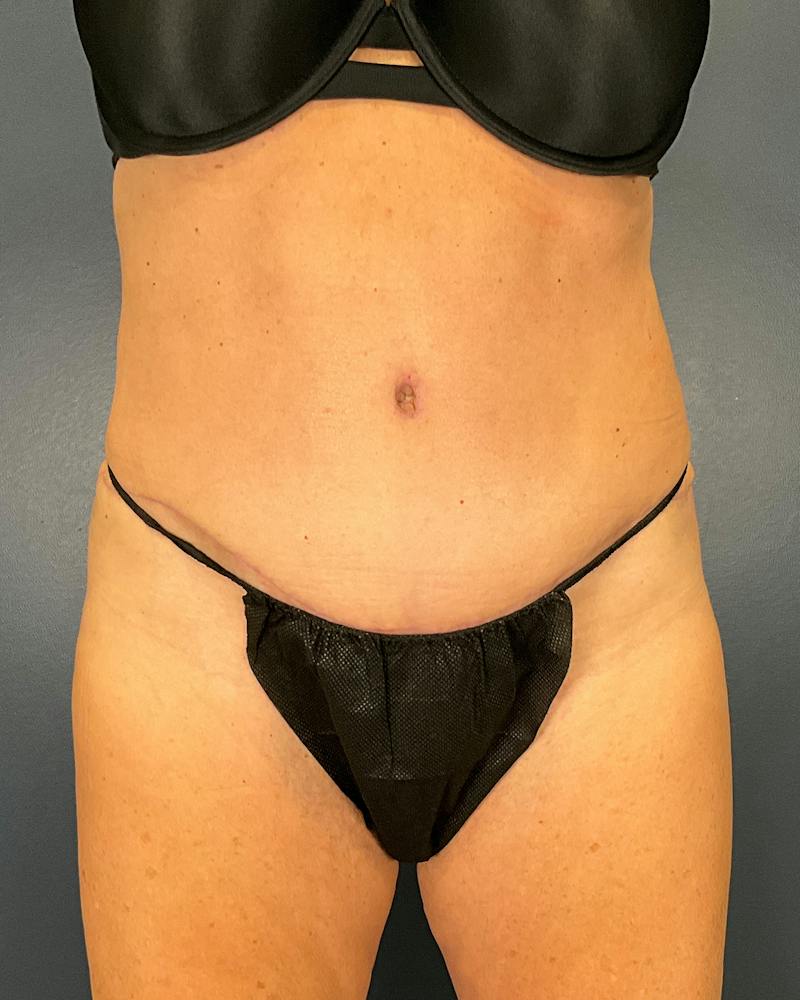 Tummy Tuck Before & After Gallery - Patient 565599 - Image 2