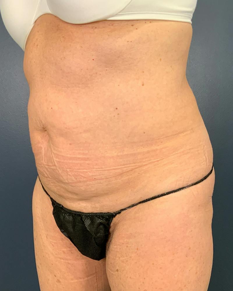 Tummy Tuck Before & After Gallery - Patient 565599 - Image 3