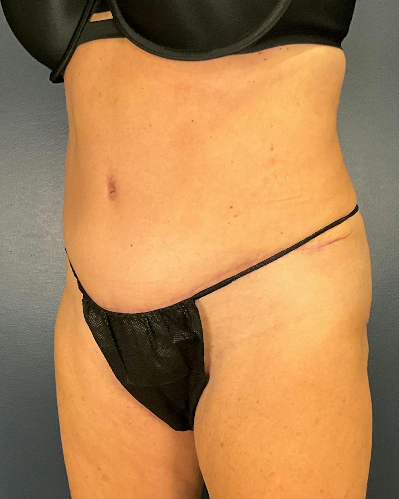 Tummy Tuck Before & After Gallery - Patient 565599 - Image 4