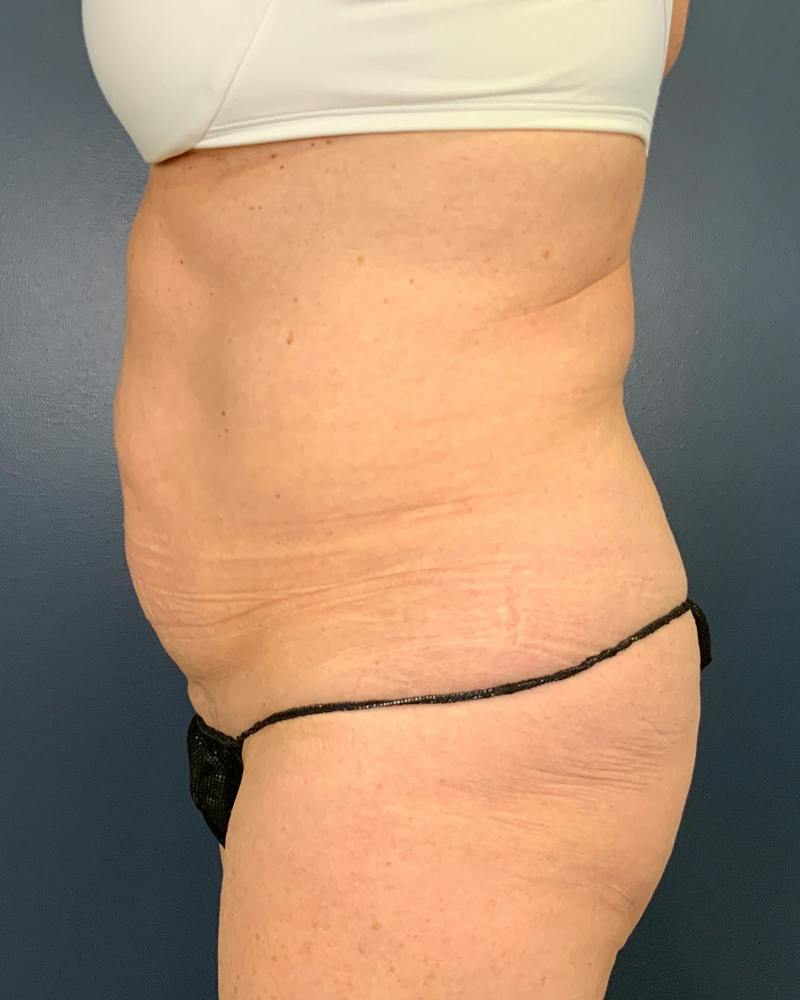 Tummy Tuck Before & After Gallery - Patient 565599 - Image 5