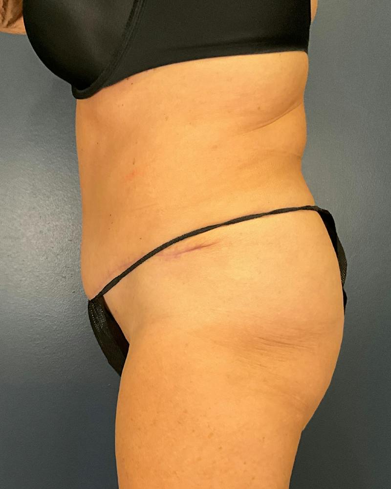 Tummy Tuck Before & After Gallery - Patient 565599 - Image 6
