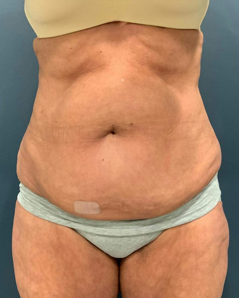 Tummy Tuck Before & After Gallery - Patient 353999 - Image 1