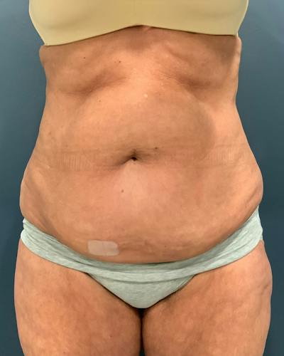 Tummy Tuck Before & After Gallery - Patient 353999 - Image 1
