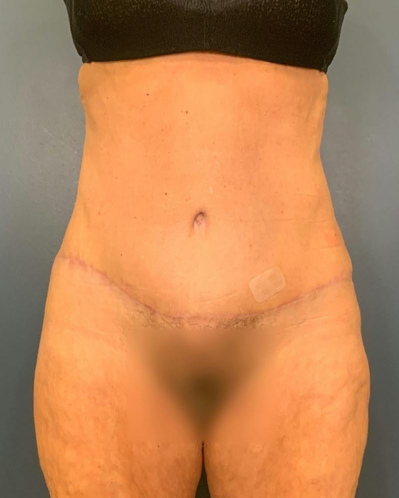 Tummy Tuck Before & After Gallery - Patient 353999 - Image 2