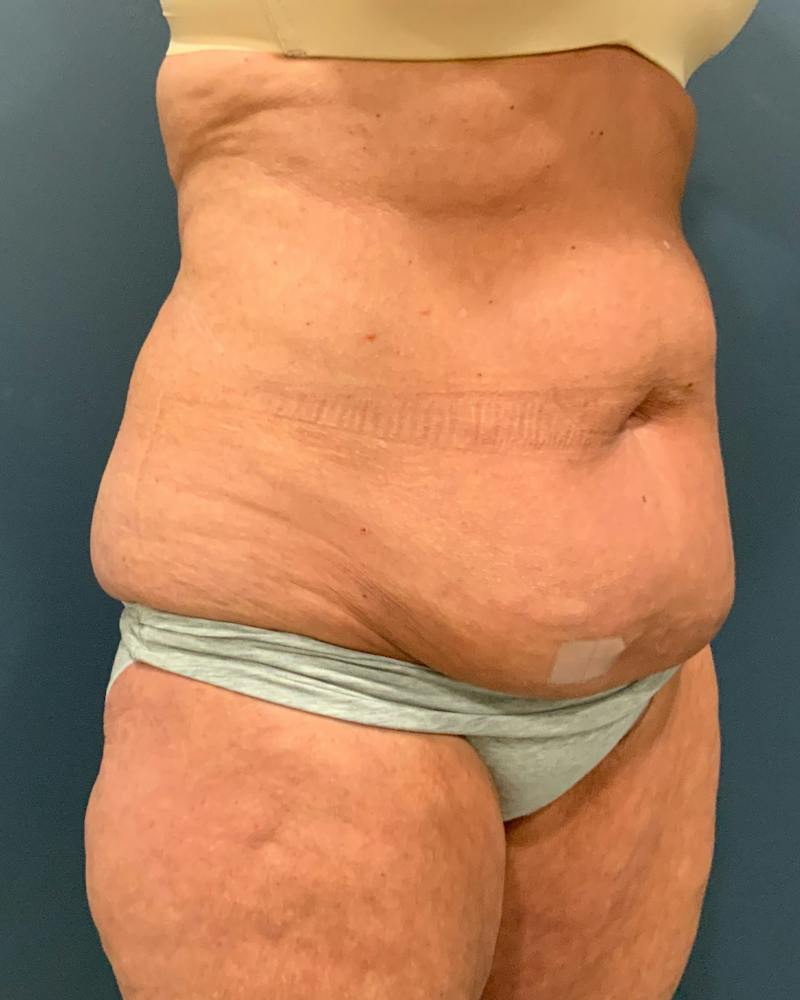 Tummy Tuck Before & After Gallery - Patient 353999 - Image 3