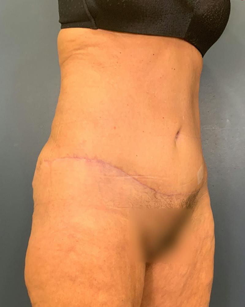 Tummy Tuck Before & After Gallery - Patient 353999 - Image 4