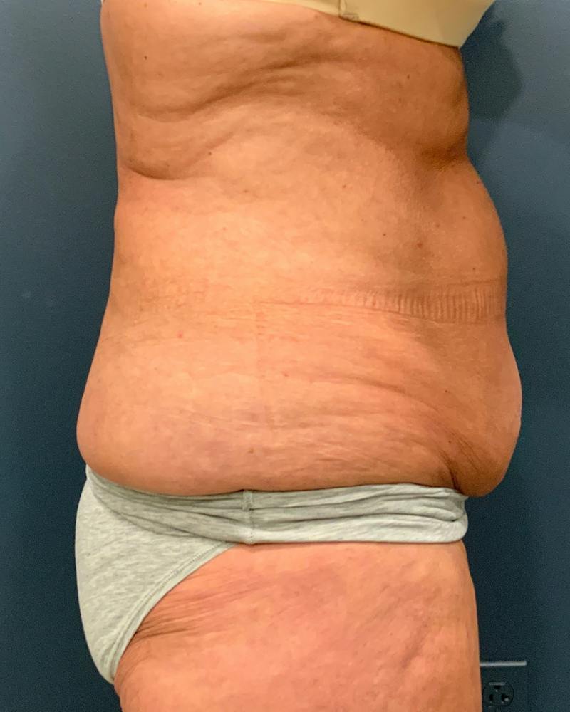 Tummy Tuck Before & After Gallery - Patient 353999 - Image 5