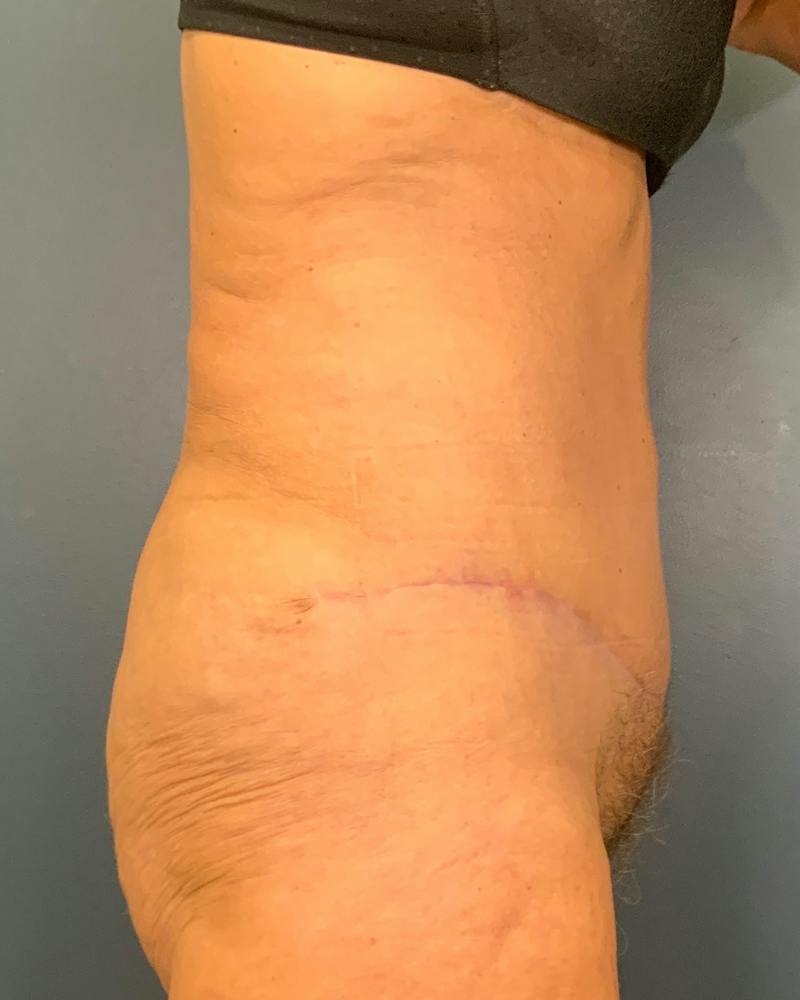 Tummy Tuck Before & After Gallery - Patient 353999 - Image 6
