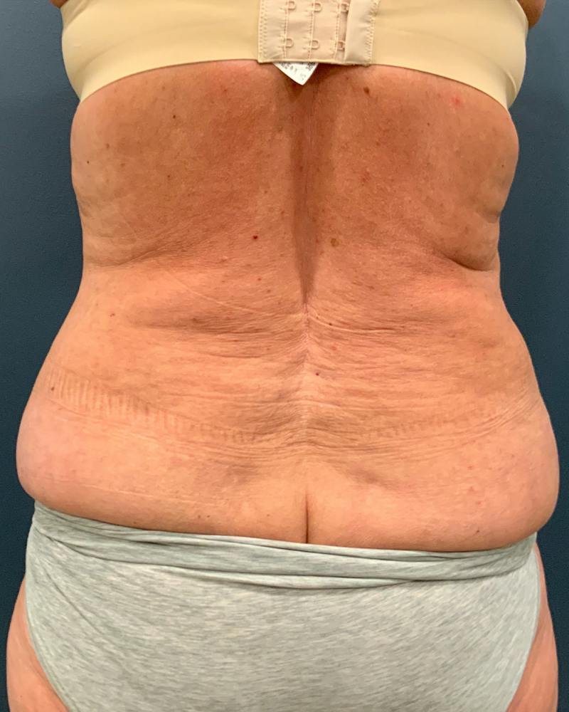Tummy Tuck Before & After Gallery - Patient 353999 - Image 7