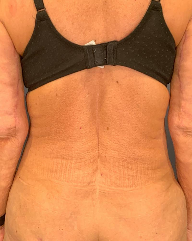 Tummy Tuck Before & After Gallery - Patient 353999 - Image 8